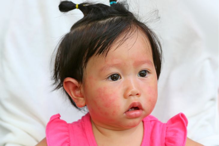 bébé avec un eczema