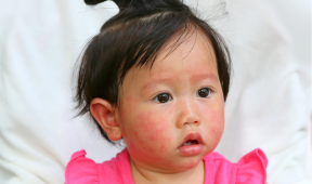 bébé avec un eczema